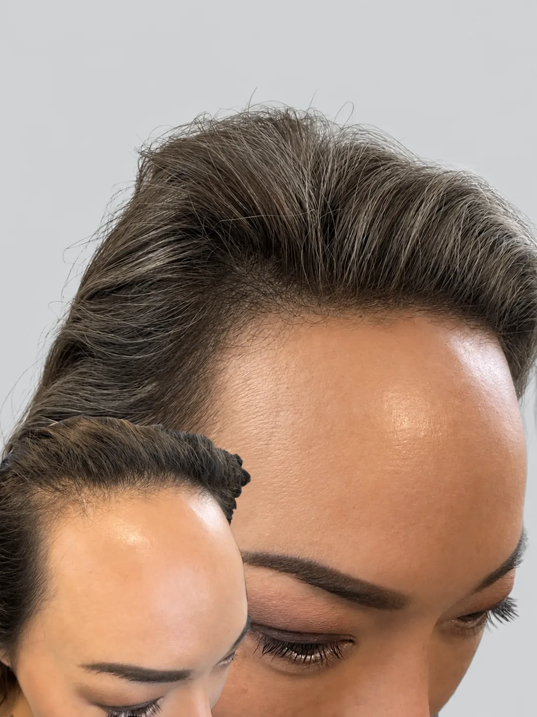 Hairline and part-line density scalp micropigmentation for women, shown before and after
